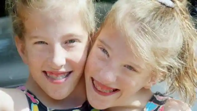 25+ Interesting Facts About Famous Conjoined Twins Abby And Brittany Hensel