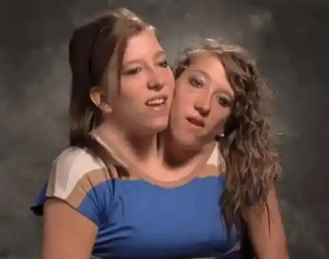 25 Interesting Facts About Famous Conjoined Twins Abby And Brittany Hensel